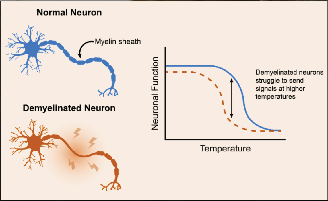 Diagram of normal neuron and demyelinated neuron